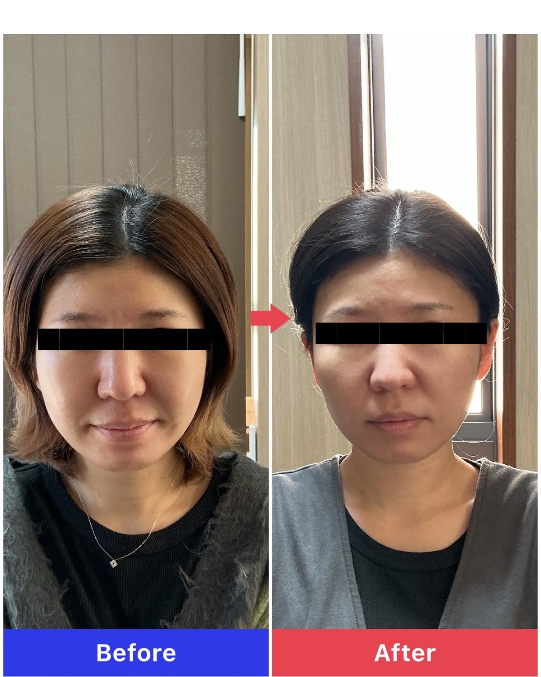 スタンダード美容鍼