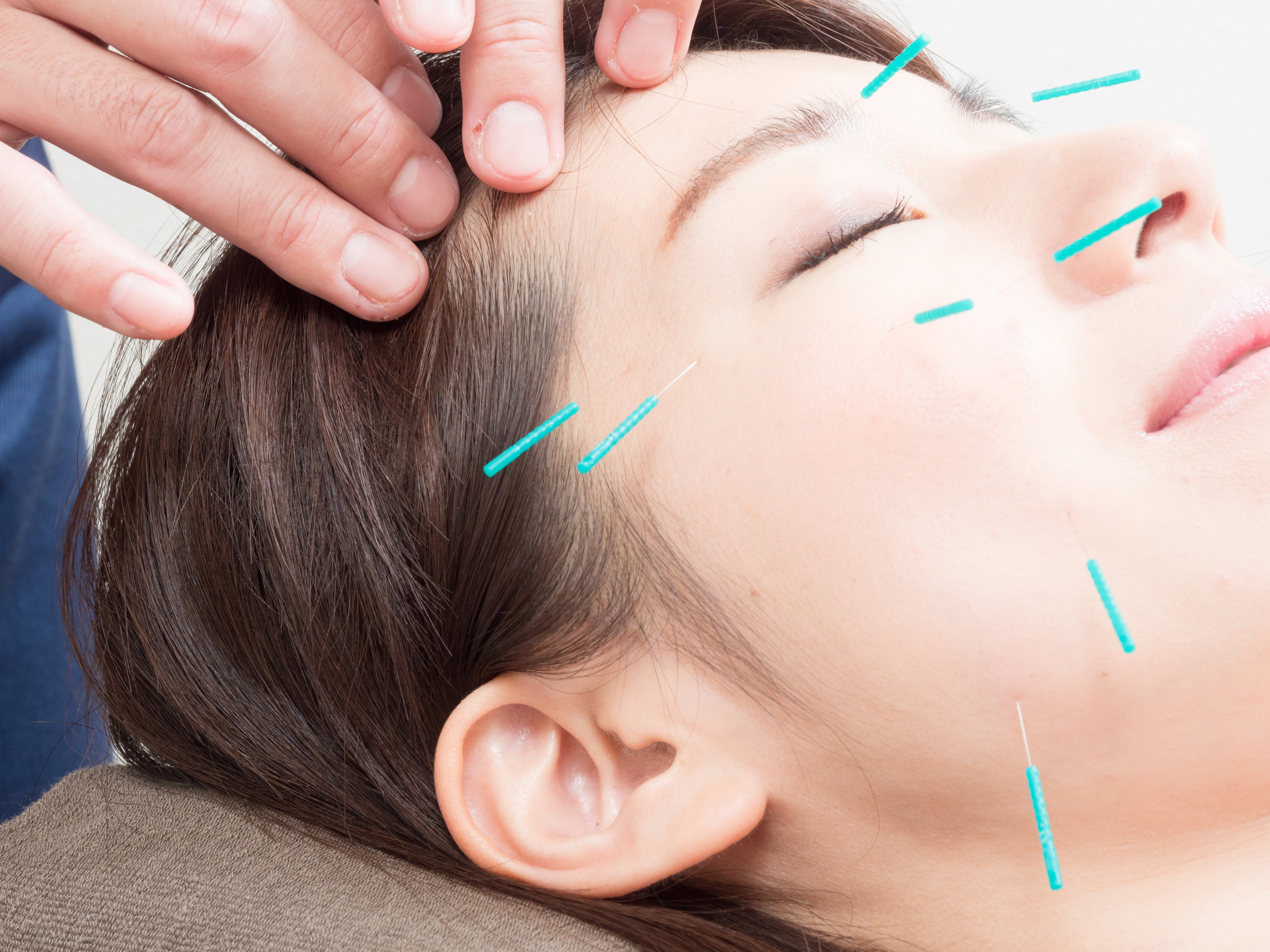 スペシャル美容鍼