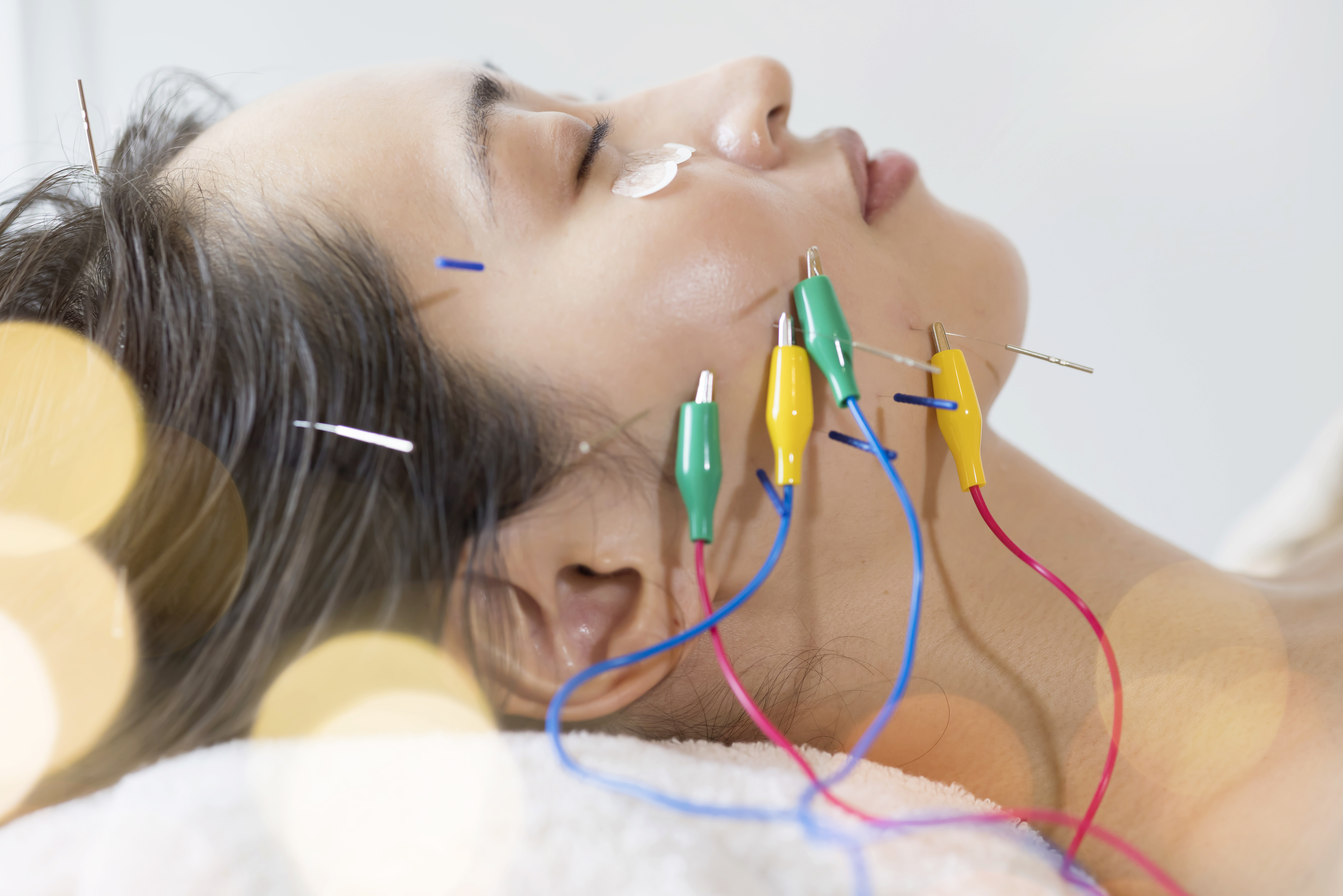 プレミアム美容鍼