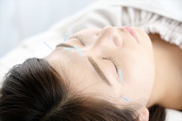美容鍼